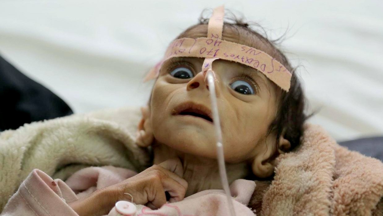 Die Hungersnot und der vergessene Krieg. Die Unterernährungsrate bei Kindern stieg seit 2014 um 200% an