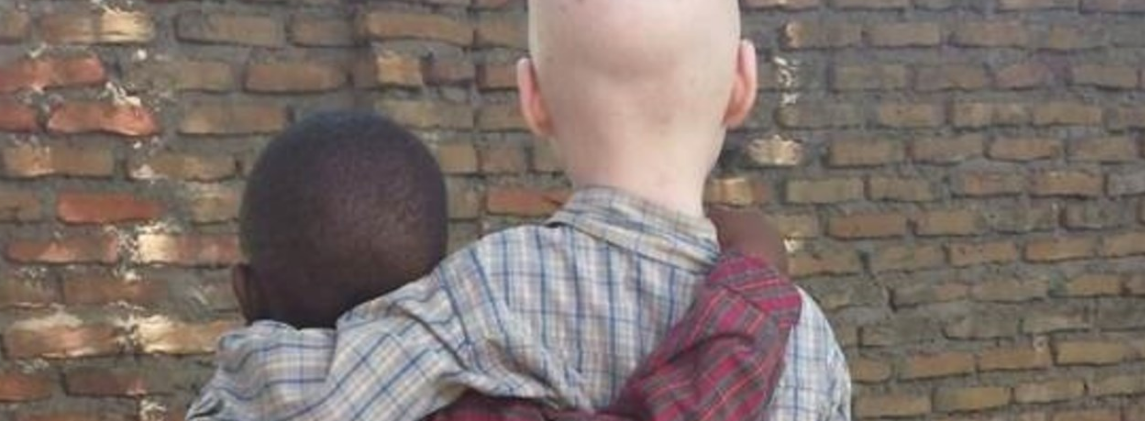 Malawi: Intensifiquen las medidas para acabar con los asesinatos rituales de personas con albinismo